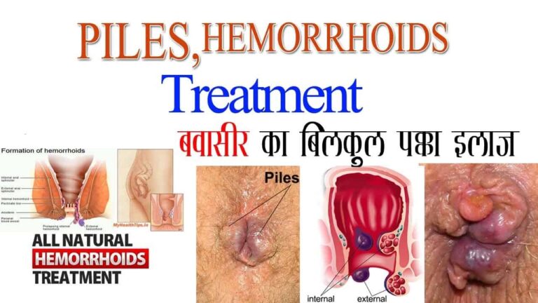 What are the symptoms of Hemorrhoids – Piles Treatment